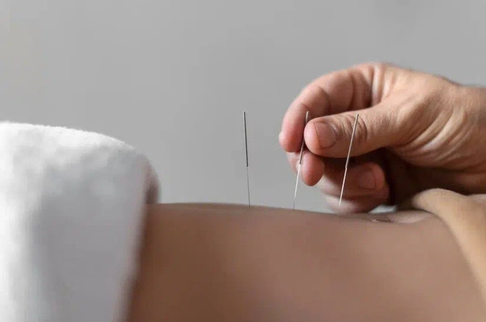 acupuncture for stress and anxiety